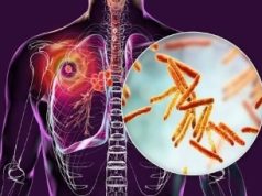 Nigeria Closes Tuberculosis Detection Gap As Molecular Testing Drives New Hope