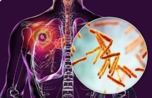 Nigeria Closes Tuberculosis Detection Gap As Molecular Testing Drives New Hope